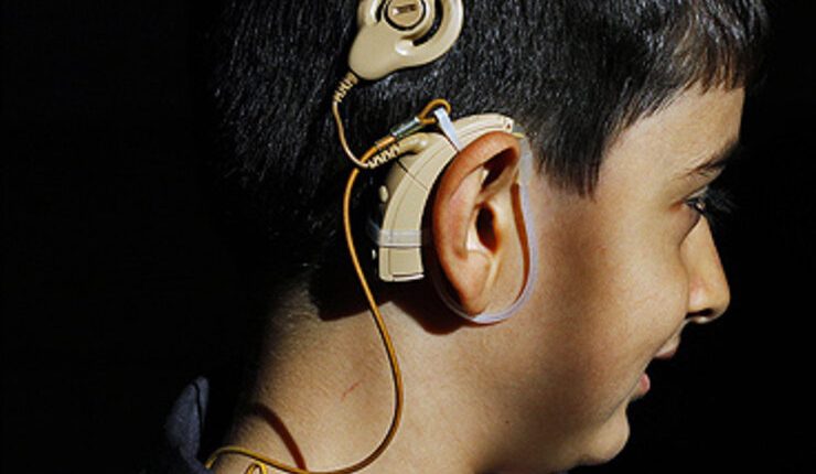 گیلان قطب چهارم کاشت حلزون شنوایی در کشور